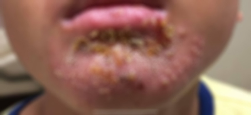 น้ำเหลืองไม่ดี น้ำเหลืองไม่ดี