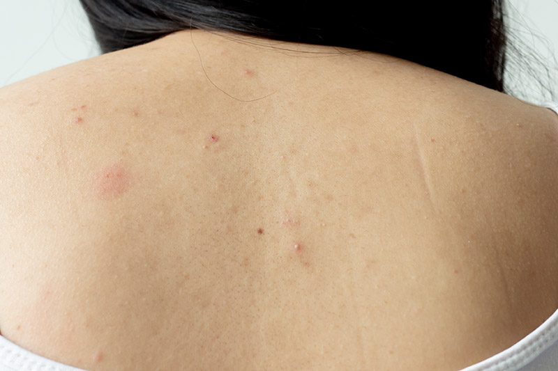 สิวที่หลัง สิวที่หลัง