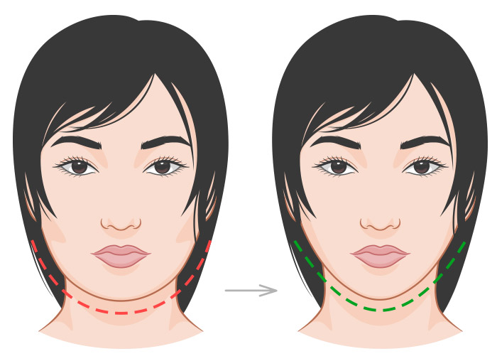 เสริมคาง เสริมคาง