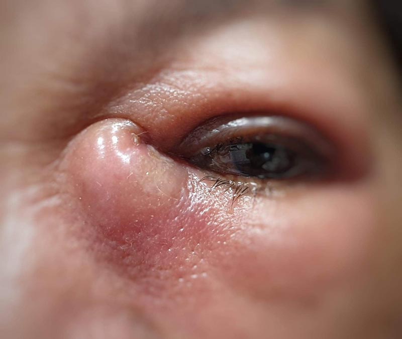 โรคท่อน้ำตาอุดตัน โรคท่อน้ำตาอุดตัน