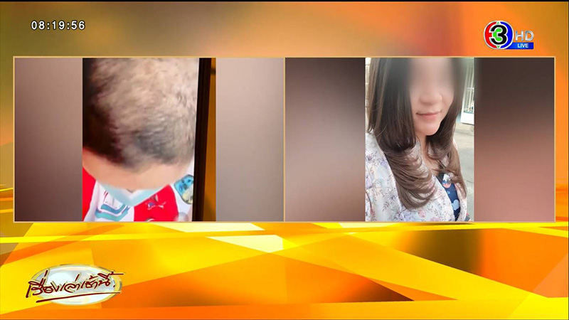 พยาบาลสาวเปิดใจ ผมร่วงหนักหลังฉีดเข็ม 3 พยาบาลสาวเปิดใจ ผมร่วงหนักหลังฉีดเข็ม 3