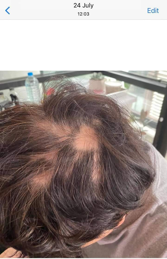 พยาบาลสาวเปิดใจ ผมร่วงหนักหลังฉีดเข็ม 3 พยาบาลสาวเปิดใจ ผมร่วงหนักหลังฉีดเข็ม 3