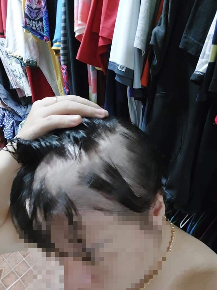 พยาบาลสาวเปิดใจ ผมร่วงหนักหลังฉีดเข็ม 3 พยาบาลสาวเปิดใจ ผมร่วงหนักหลังฉีดเข็ม 3
