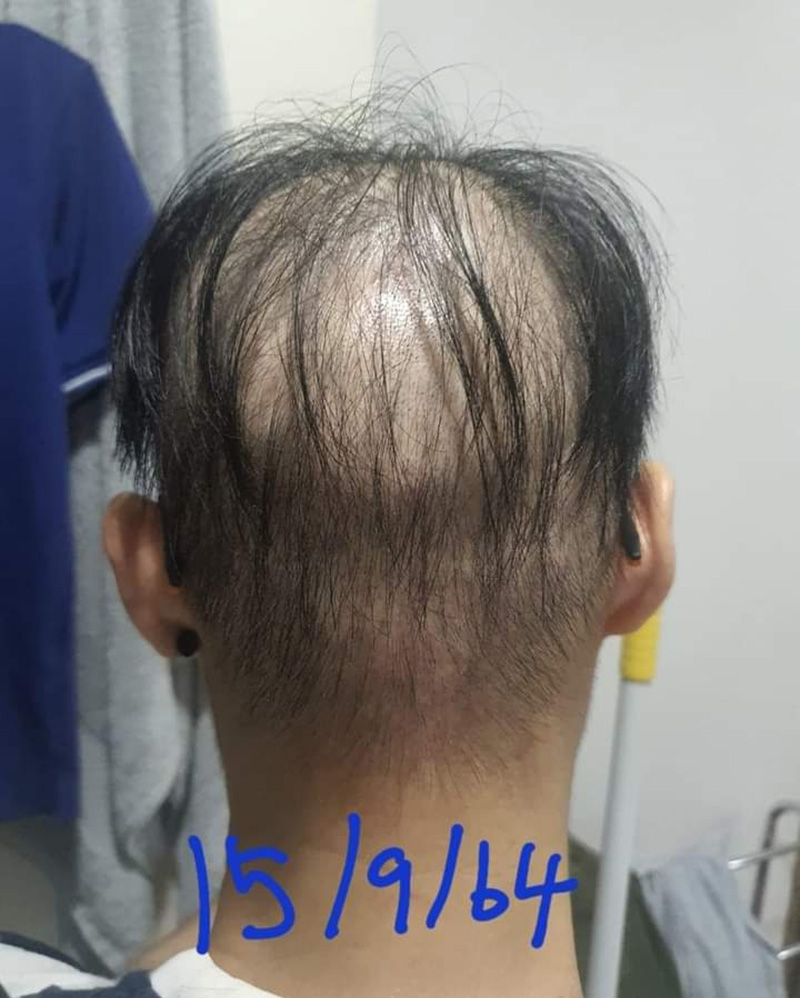 พยาบาลสาวเปิดใจ ผมร่วงหนักหลังฉีดเข็ม 3 พยาบาลสาวเปิดใจ ผมร่วงหนักหลังฉีดเข็ม 3