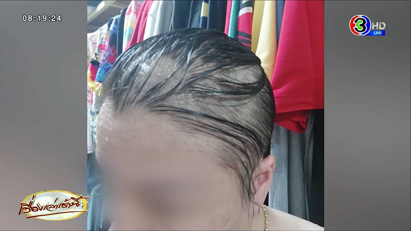 พยาบาลสาวเปิดใจ ผมร่วงหนักหลังฉีดเข็ม 3 พยาบาลสาวเปิดใจ ผมร่วงหนักหลังฉีดเข็ม 3