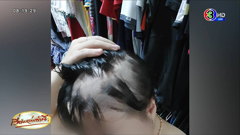 พยาบาลสาวเปิดใจ ผมร่วงหนักหลังฉีดเข็ม 3 พยาบาลสาวเปิดใจ ผมร่วงหนักหลังฉีดเข็ม 3