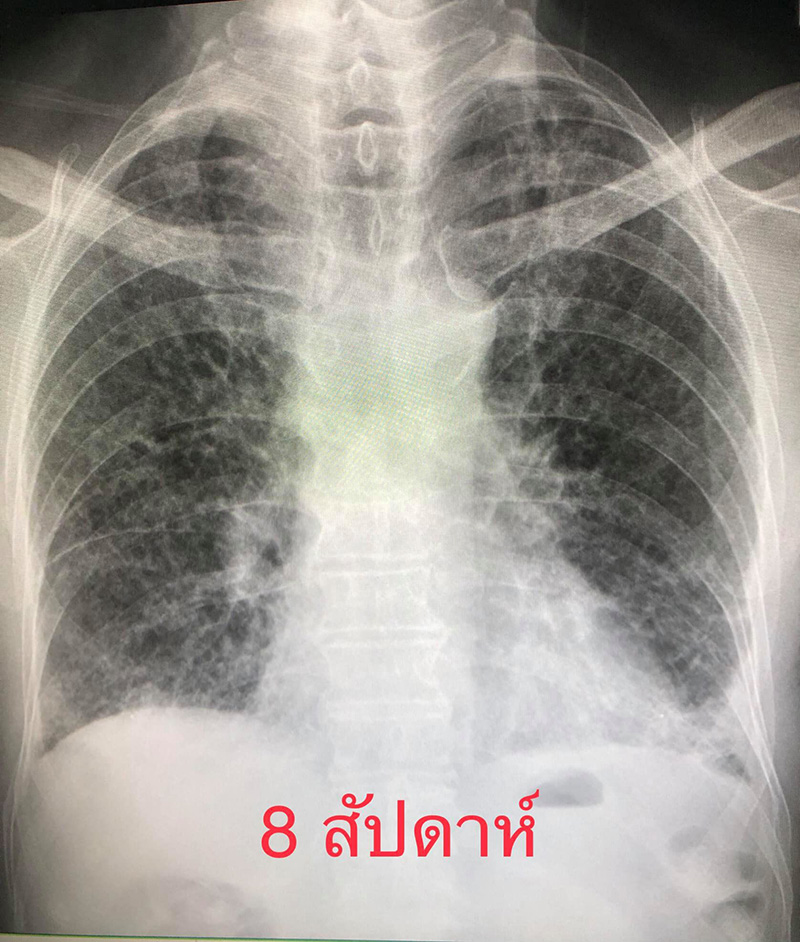 ภาพปอดผู้ป่วยโควิด 19 สายพันธุ์อัลฟา ภาพปอดผู้ป่วยโควิด 19 สายพันธุ์อัลฟา
