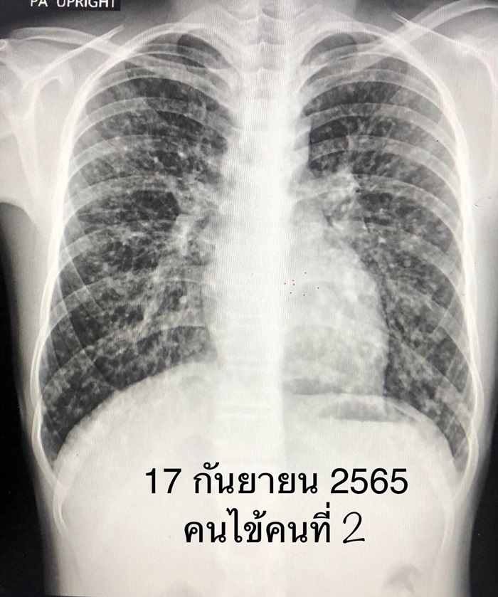 เชื้อรามูลค้างคาว เชื้อรามูลค้างคาว