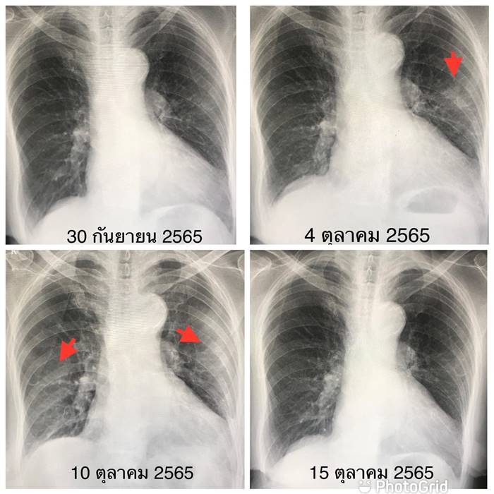 โรค RSV โรค RSV