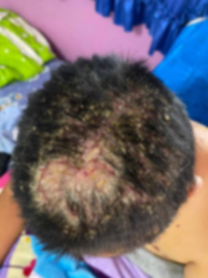 หญิงอ้างป่วยทรมานแผลพุพอง หลังรับจ้างฉีดวัคซีน หญิงอ้างป่วยทรมานแผลพุพอง หลังรับจ้างฉีดวัคซีน