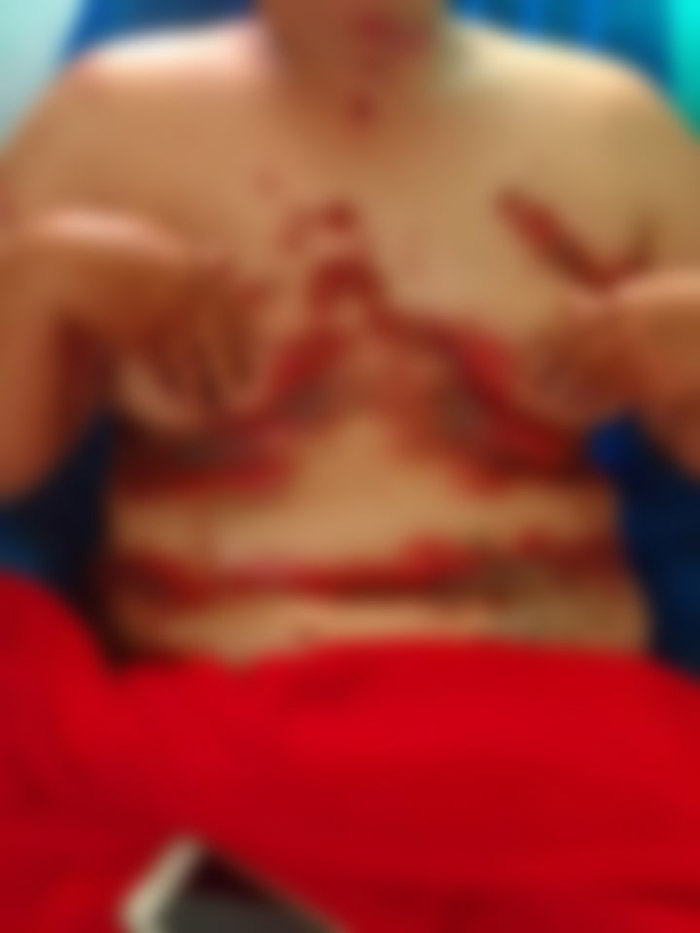 หญิงอ้างป่วยทรมานแผลพุพอง หลังรับจ้างฉีดวัคซีน หญิงอ้างป่วยทรมานแผลพุพอง หลังรับจ้างฉีดวัคซีน