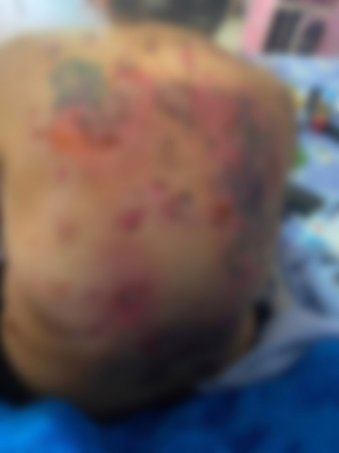 หญิงอ้างป่วยทรมานแผลพุพอง หลังรับจ้างฉีดวัคซีน หญิงอ้างป่วยทรมานแผลพุพอง หลังรับจ้างฉีดวัคซีน