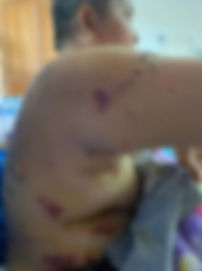 หญิงอ้างป่วยทรมานแผลพุพอง หลังรับจ้างฉีดวัคซีน หญิงอ้างป่วยทรมานแผลพุพอง หลังรับจ้างฉีดวัคซีน