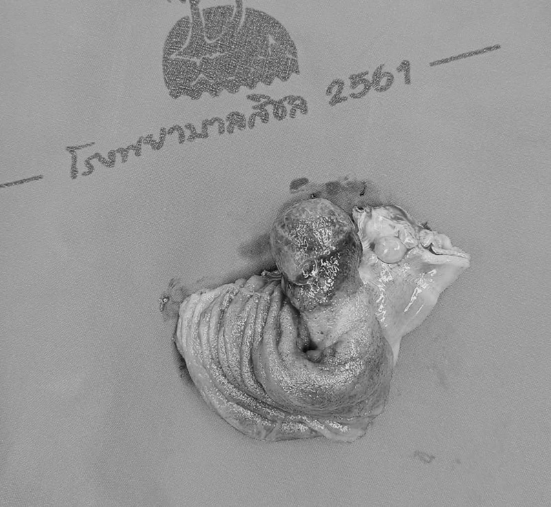 ลำไส้กลืนกัน ลำไส้กลืนกัน