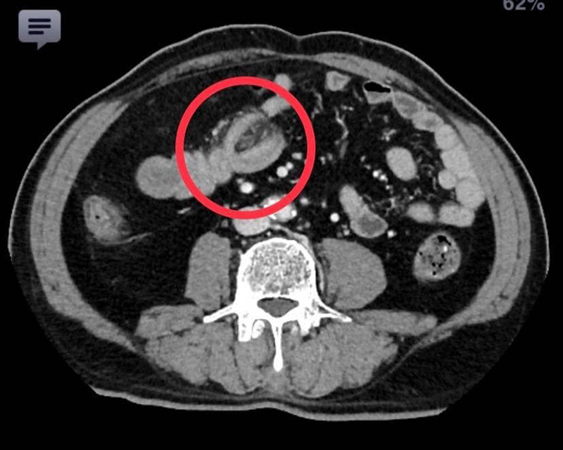 ลำไส้กลืนกัน ลำไส้กลืนกัน