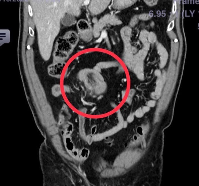 ลำไส้กลืนกัน ลำไส้กลืนกัน