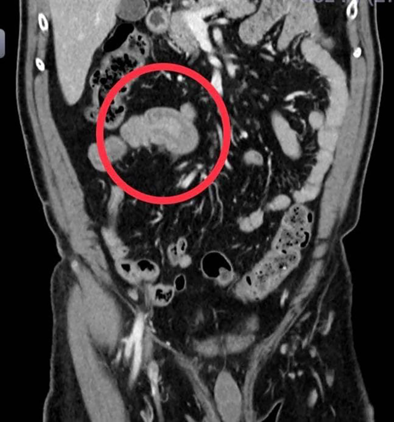 ลำไส้กลืนกัน ลำไส้กลืนกัน