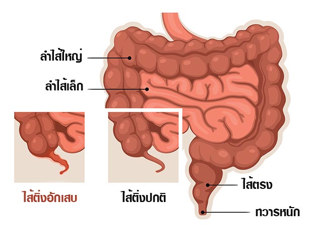 ไส้ติ่งอักเสบ ไส้ติ่งอักเสบ