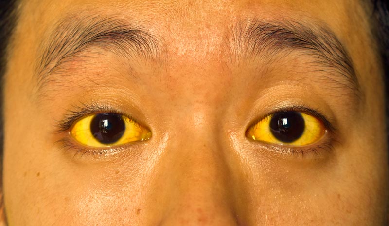 โรคฉี่หนู แบบติดเชื้อรุนแรง (Severe Leptospirosis) หรือแบบที่มีอาการเหลือง