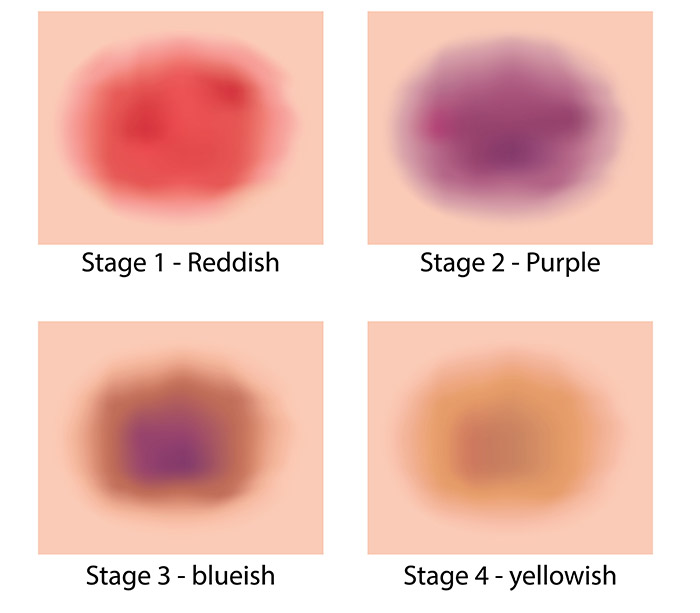 รอยช้ำ ลักษณะรอยช้ำ สีไหน บอกอะไร
