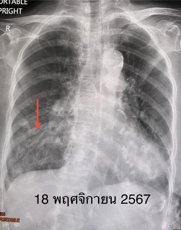ปอดอักเสบติดเชื้อแบคทีเรีย ปอดอักเสบติดเชื้อแบคทีเรีย