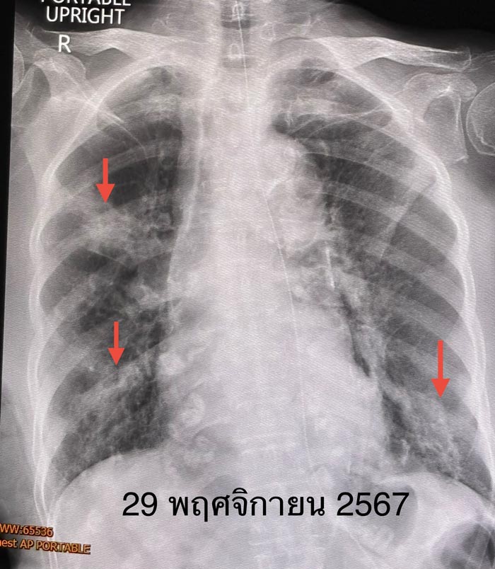 โรคปอดอักเสบติดเชื้อแบคทีเรีย โรคปอดอักเสบติดเชื้อแบคทีเรีย