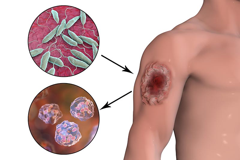 Leishmaniasis โรคลิชมาเนีย ติดต่อกันด้วยวิธีใด