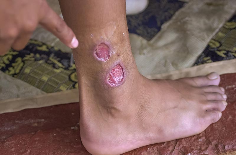 Leishmaniasis ลักษณะแผลที่เกิดจากโรคลิชมาเนีย โรคนี้หายเองได้ไหม
