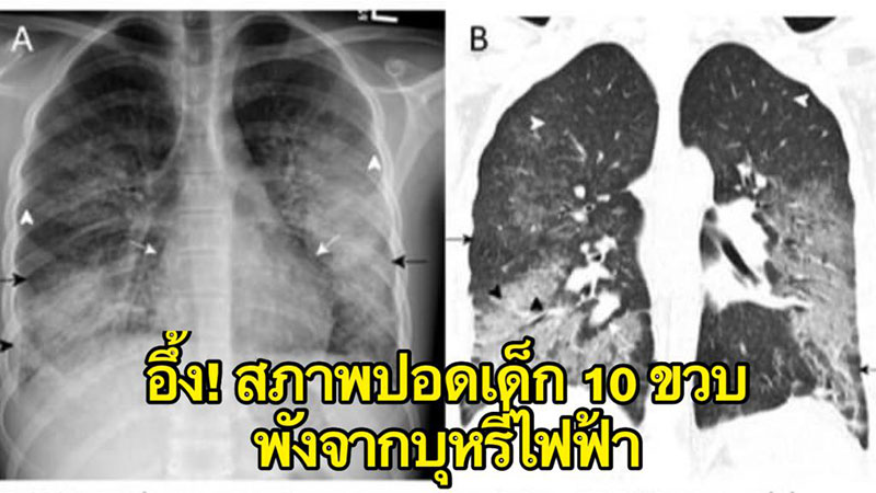 บุหรี่ไฟฟ้า โรคปอดอักเสบรุนแรงจากบุหรี่ไฟฟ้า