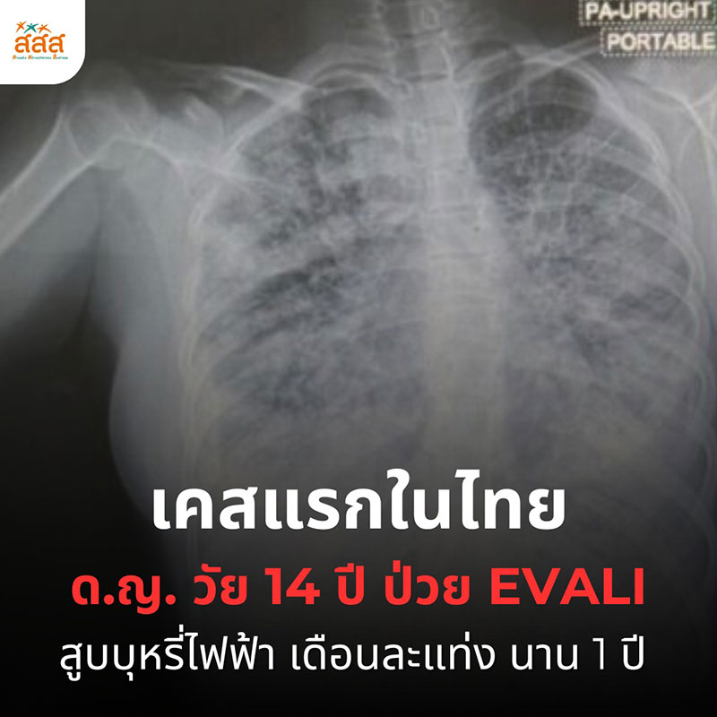 บุหรี่ไฟฟ้า โรคปอดอักเสบรุนแรงจากบุหรี่ไฟฟ้า