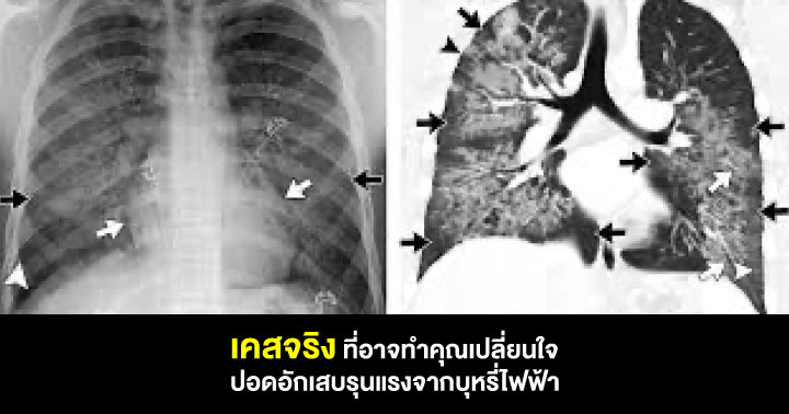 บุหรี่ไฟฟ้า บุหรี่ไฟฟ้า อันตราย