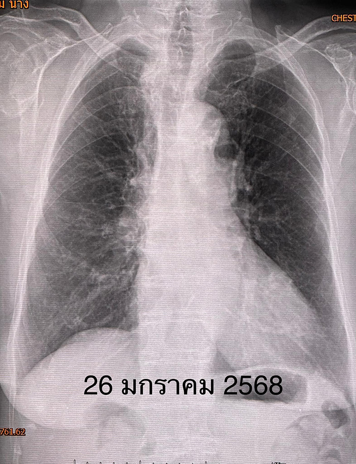 เปิดแอร์เข้าพักในคอนโด สุดท้ายปอดอักเสบ เปิดแอร์เข้าพักในคอนโด สุดท้ายปอดอักเสบ