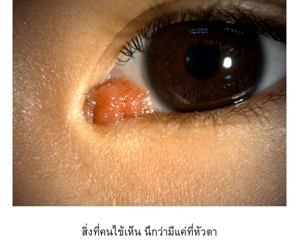 หูดที่เยื่อบุตา หูดที่เยื่อบุตา