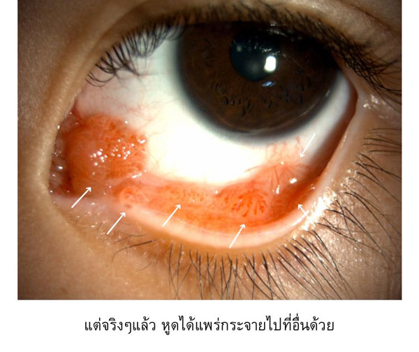 หูดที่เยื่อบุตา หูดที่เยื่อบุตา