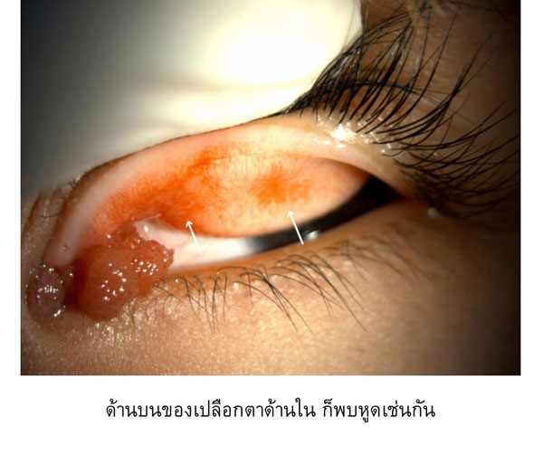 หูดที่เยื่อบุตา หูดที่เยื่อบุตา