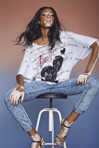 นางแบบผิวด่างขาว นางแบบผิวด่างขาว