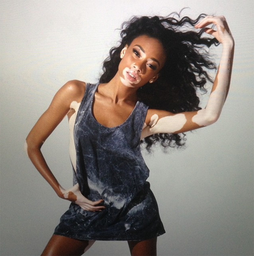 นางแบบผิวด่างขาว นางแบบผิวด่างขาว