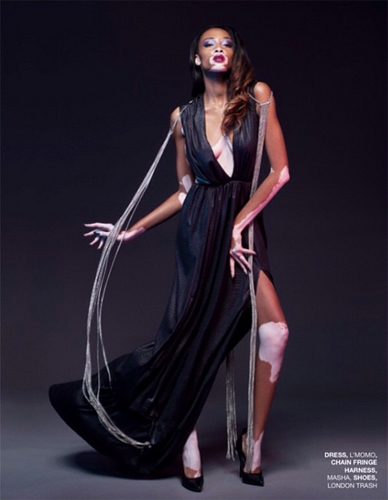 นางแบบผิวด่างขาว นางแบบผิวด่างขาว