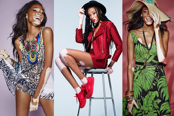 นางแบบผิวด่างขาว นางแบบผิวด่างขาว