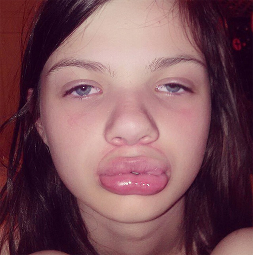 ทำปากอวบอิ่ม, ทำปากอวบอิ่ม,