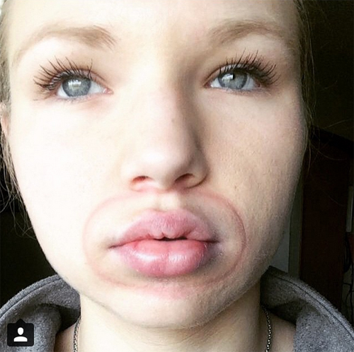 ทำปากอวบอิ่ม, ทำปากอวบอิ่ม,