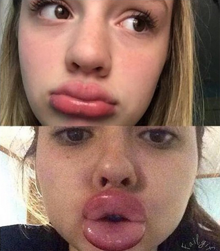 ทำปากอวบอิ่ม, ทำปากอวบอิ่ม,