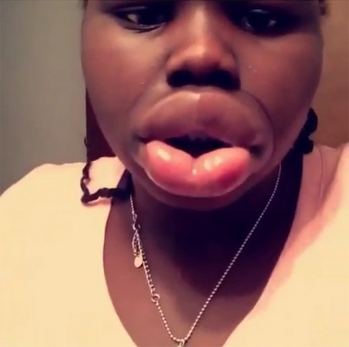 ทำปากอวบอิ่ม, ทำปากอวบอิ่ม,