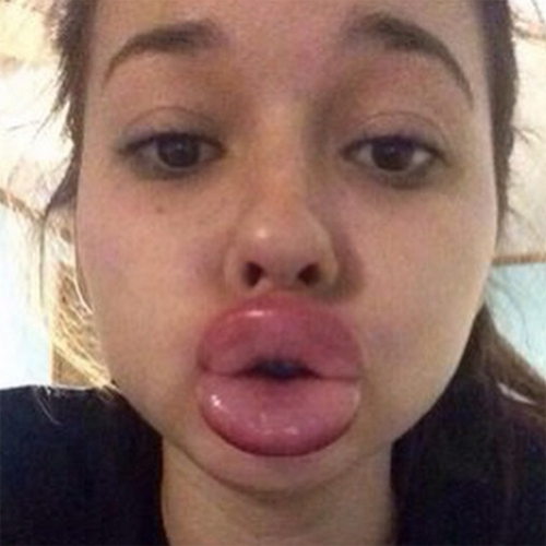 ทำปากอวบอิ่ม, ทำปากอวบอิ่ม,