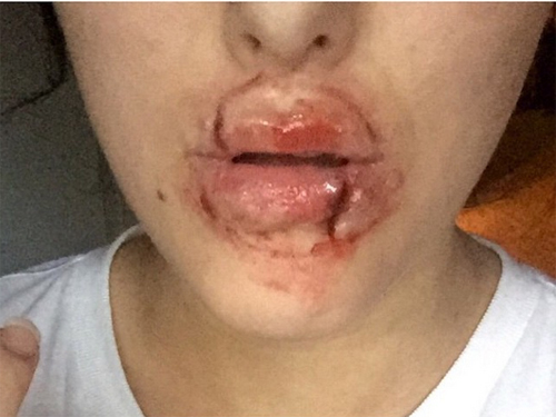 ทำปากอวบอิ่ม ทำปากอวบอิ่ม