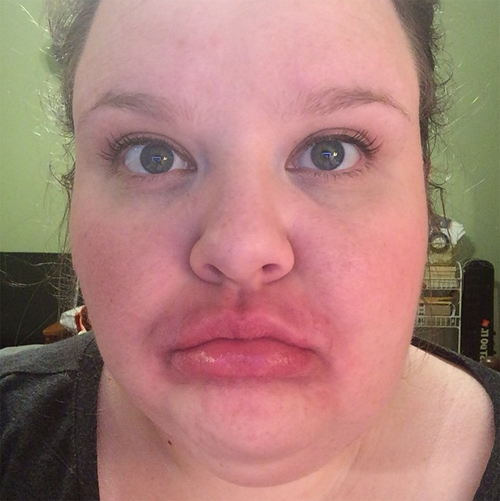 ทำปากอวบอิ่ม ทำปากอวบอิ่ม