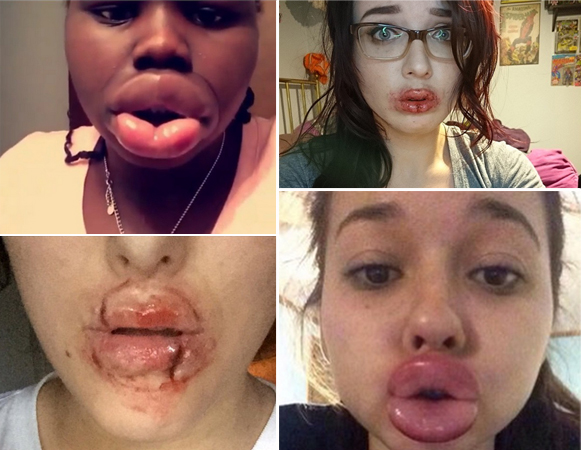 ทำปากอวบอิ่ม, ทำปากอวบอิ่ม,