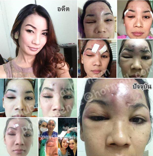 ศัลยกรรมทำพิษ ศัลยกรรมทำพิษ