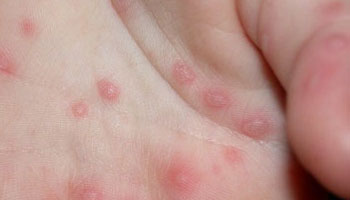 มือ เท้า ปาก