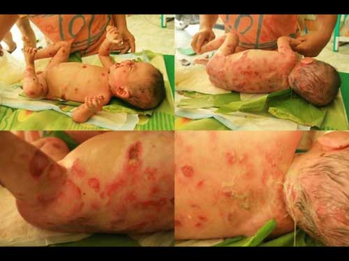 น้องเคน ป่วยโรคน้ำเหลืองใส